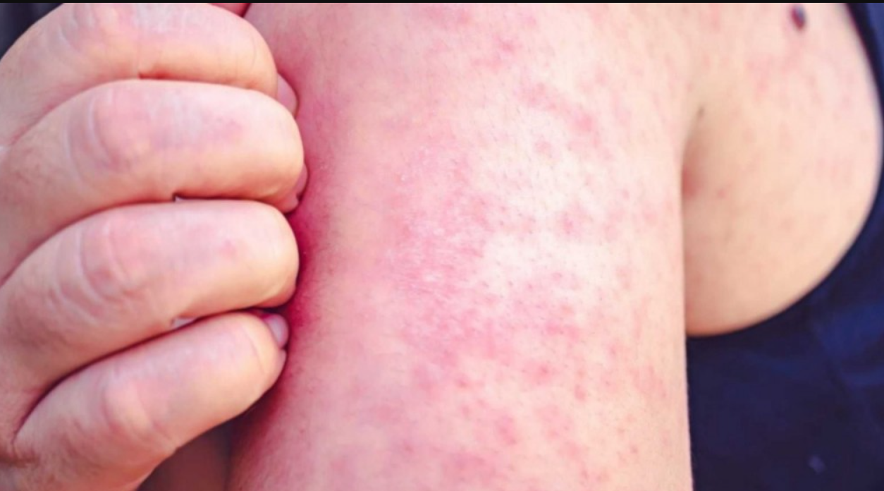 "El brote de sarampión es porque no nos vacunamos", aseguró el infectólogo Hugo Pizzi | Información General