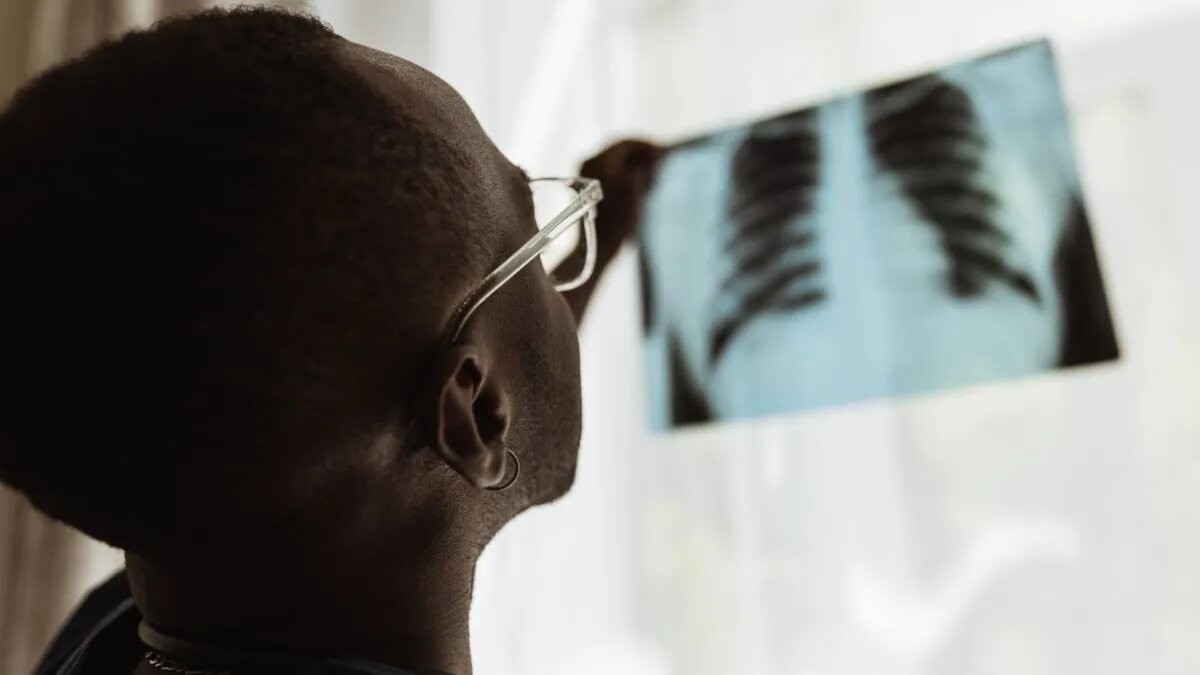 Los casos de tuberculosis aumentaron un 38% en Argentina | Información General