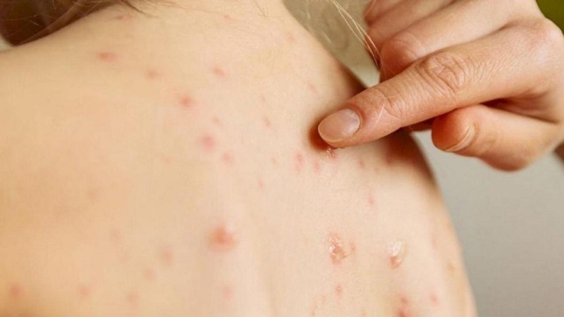 Intensifican controles en Santa Fe ante el riesgo de un brote de sarampión | Rosario y la región