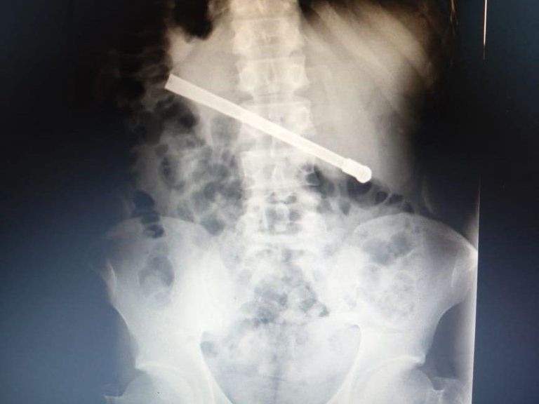 Interno condenado por abuso sexual fue operado tras ingerir una bombilla | Rosario y la región