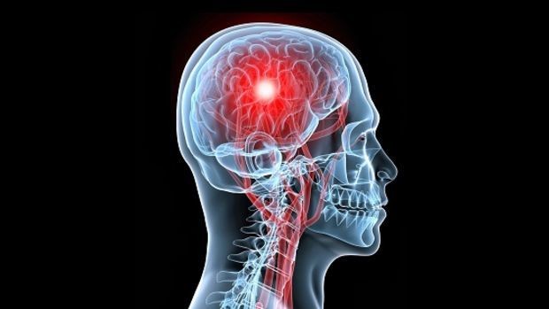 El eje psicológico del ACV: cuando la presión no es solo arterial | Información General