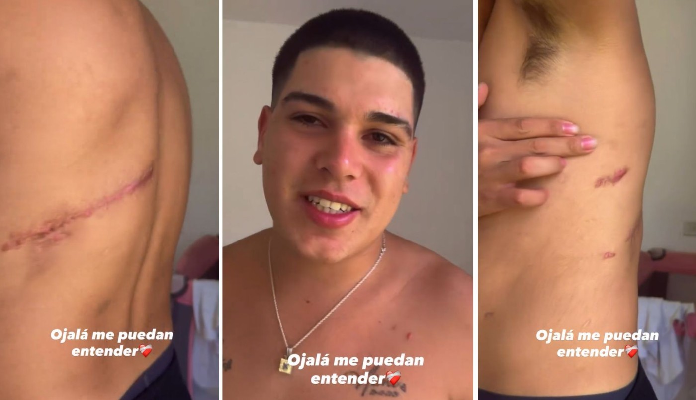 Thiago Medina mostró las secuelas del grave accidente que casi le cuesta la vida: “Tengo complejo con mis cicatrices” | Espectáculos