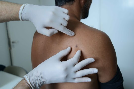 Gratis y sin turno: hospitales de Rosario adhieren a la campaña de prevención del cáncer de piel | Información General