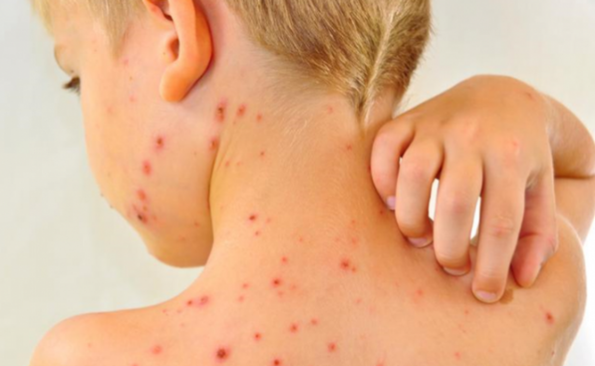 Confirman un caso de rubeola en la ciudad de Buenos Aires en un nene no vacunado | Información General