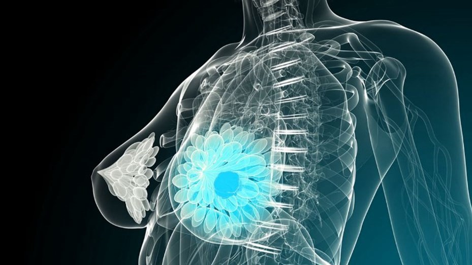 Estados Unidos: consiguen eliminar una metástasis de cáncer de mama por primera vez | Internacionales