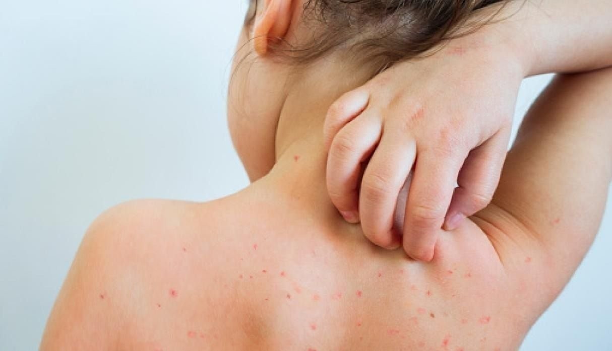 Una mujer 'antivacunas' contagió de sarampión a sus cinco hijos | Información General