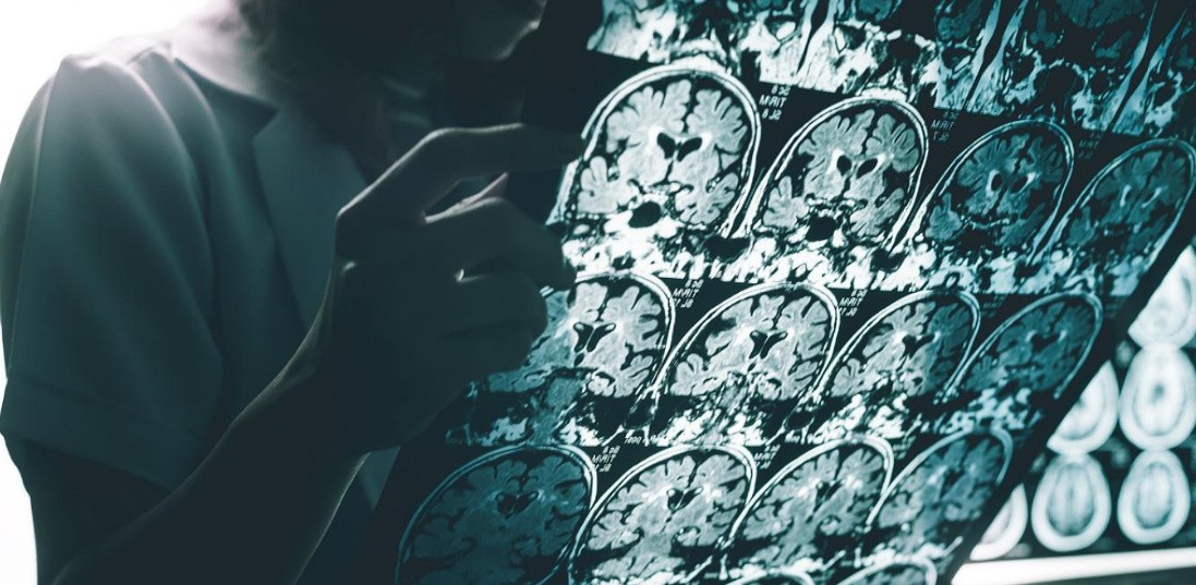 Descubren un nuevo gen relacionado con el riesgo de desarrollar Alzheimer | Información General