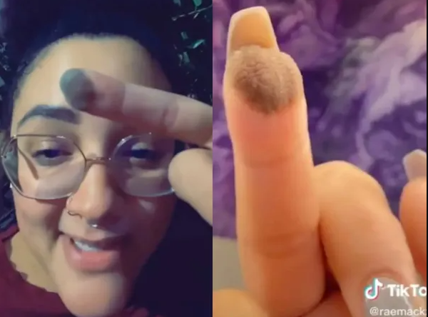 El extraño caso de una mujer que le crece vello púbico en un dedo a causa de un injerto de piel | Tecnología