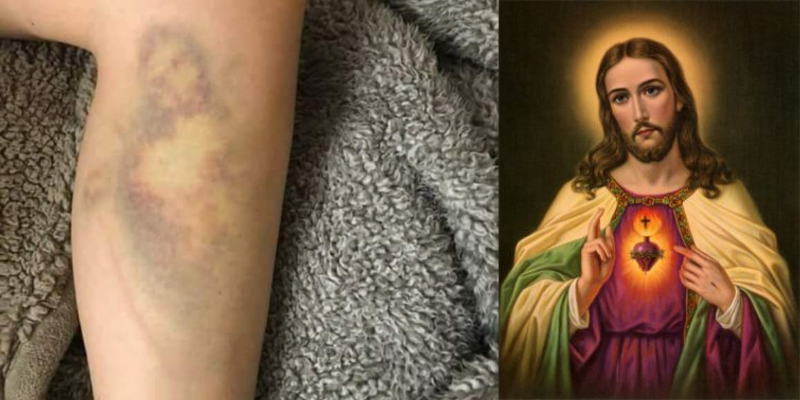 Se cayó de la bicicleta y le salió un moretón con la cara de Jesús | Tecnología