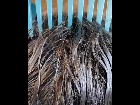 Video estremecedor: millones de piojos caminando en la cabeza de una nena | Tecnología