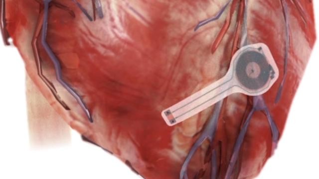 Crearon un marcapasos que se disuelve en el cuerpo | Tecnología