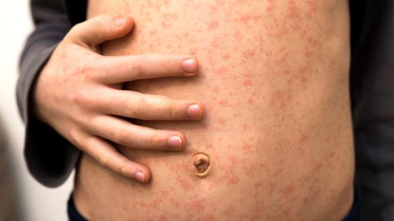 Sarampión: cómo se contagia, quiénes deben vacunarse, quiénes no y, ¿es mortal? | Información General