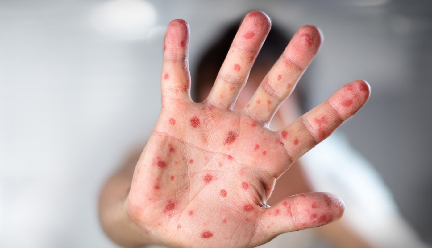 Confirmaron el segundo contagiado por la viruela del mono en Rosario | Rosario y la región