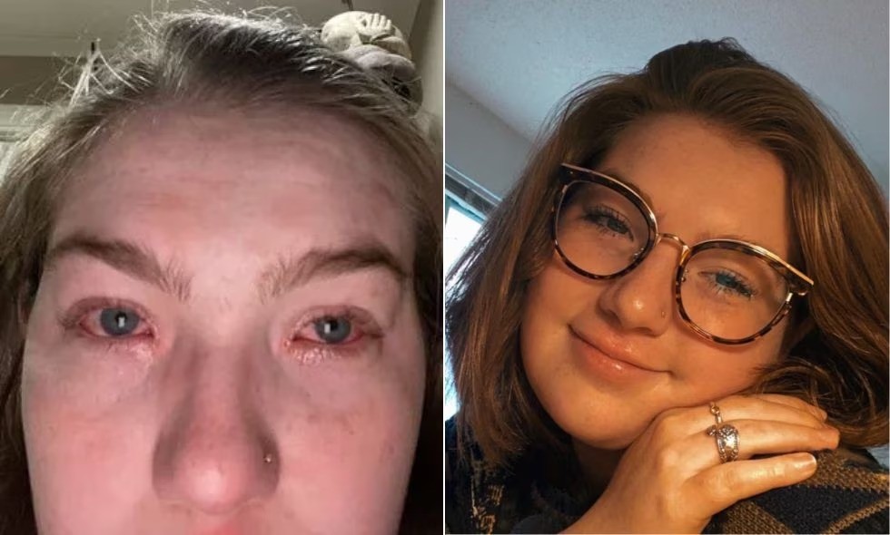 Insólito: una joven descubrió que es alérgica a su novio y explotaron las redes | Internacionales