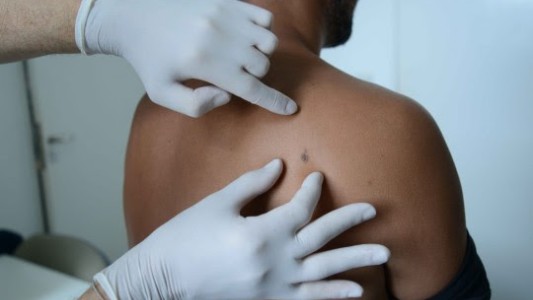 Gratis y sin turno: hospitales de Rosario adhieren a la campaña de prevención del cáncer de piel