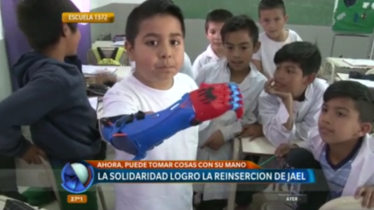 Jael pudo recuperar funcionalmente su mano gracias a un implante 3D