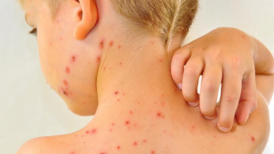 Confirman un caso de rubeola en la ciudad de Buenos Aires en un nene no vacunado