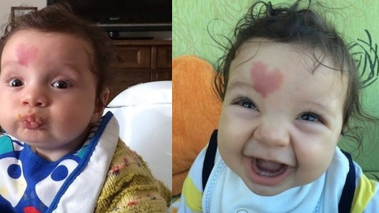 Furor mundial por "Baby Love" el niño que nació con un corazón en la frente