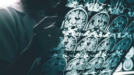 Descubren un nuevo gen relacionado con el riesgo de desarrollar Alzheimer