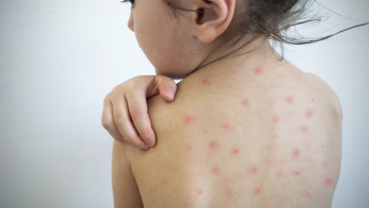 Confirman 142 casos de sarampión en la provincia de Buenos Aires