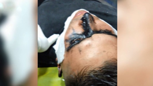 San Lorenzo: un policía fue atacado arrojándole alquitrán en el rostro