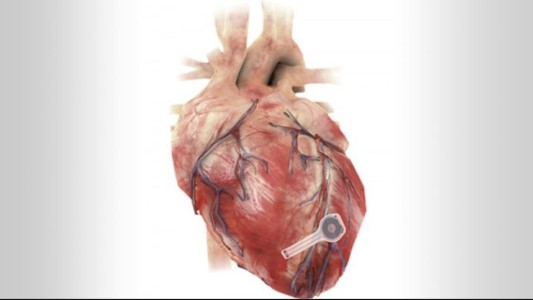 Crean un primer marcapasos biodegradable: desaparece cuando ya no es necesario