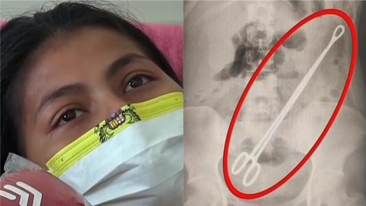 Vivió seis meses con una pinza de 20 centímetros en el vientre tras dar a luz