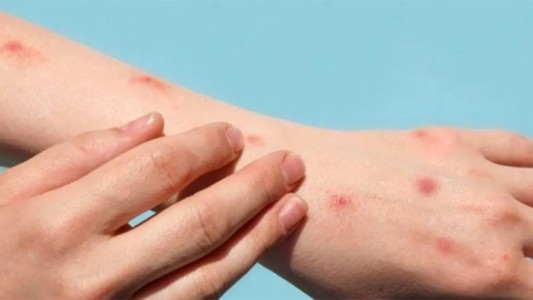 Confirmaron el primer caso de viruela símica en la capital provincial