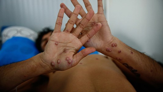 Viruela de mono: se confirmó el segundo caso en Rosario