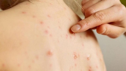 Intensifican controles en Santa Fe ante el riesgo de un brote de sarampión