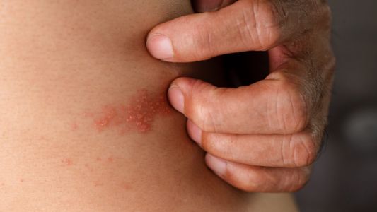 Del miedo al alivio: cómo el herpes zóster se confundió con ébola en San Lorenzo