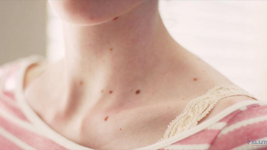 Hasta el viernes se realizan controles gratuitos para la detección precoz de cáncer de piel