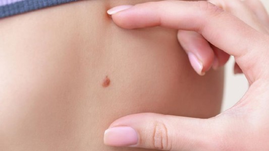 Realizan controles gratuitos para prevenir el cáncer de piel