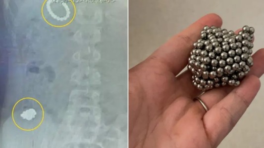 Operado de emergencia a un nene: se tragó más de 50 imanes para volverse magnético