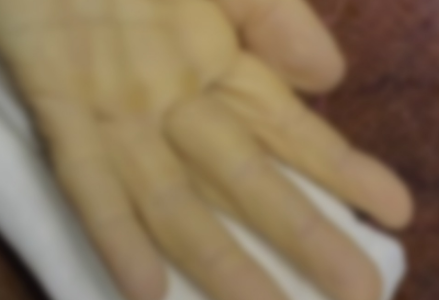 Realizaron un exitoso trasplante de mano en Córdoba