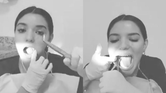Dentista publicó un video para mostrar cómo se sacaba sola las muelas de juicio