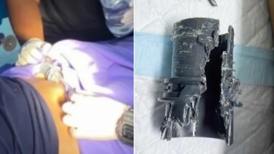 Se agrandó el pene y se le quedó atascado en un tubo que usó para comprobar el nuevo tamaño