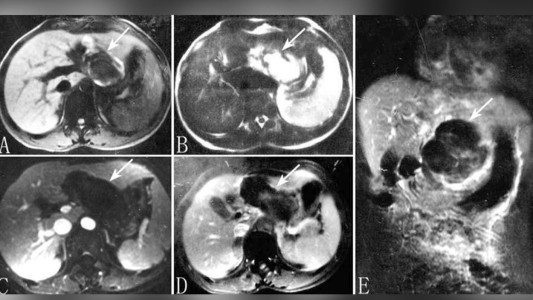 "Jamás vi algo así": un pediatra atendió a una mujer embarazada con el feto en el hígado