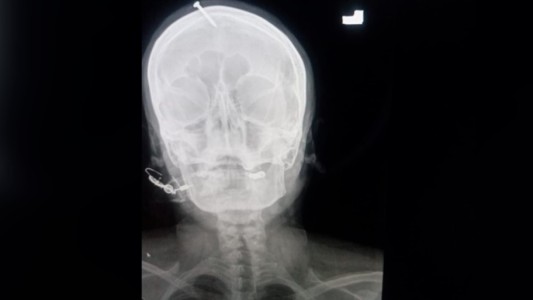 Curandero le puso un clavo en la cabeza a una embarazada para garantizarle que tenga un varón