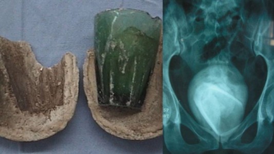 Fue al médico pensando que tenía una infección urinaria y le hallaron un vaso en la vejiga: lo usó como juguete sexual