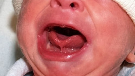 La moda de cortar el frenillo de la lengua de los bebés para favorecer la lactancia