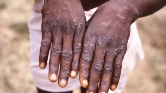 La OMS cambiará el nombre de la viruela del mono para evitar casos de discriminación