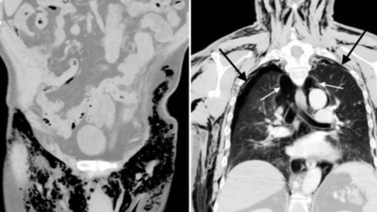 "Escroto silbante": tras una operación, le sonaban los testículos y casi le cuesta la vida
