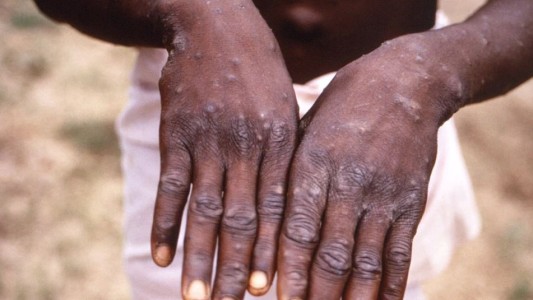 Viruela del mono: la OMS reclamó medidas "urgentes" en Europa para contener la propagación de la enfermedad