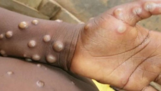 La OMS aconseja a gays reducir las parejas sexuales ante el brote de viruela del mono