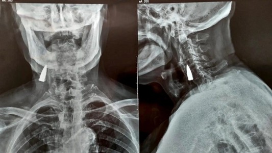 Tras sufrir una caída en su balcón, fue al hospital y descubrieron que tenía una bala en el cuello