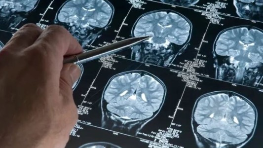 Estados Unidos aprobó el uso de un fármaco que retrasa moderadamente el Alzheimer