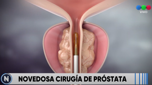 Una nueva intervención de próstata, con buenos resultados