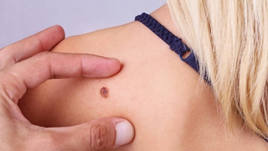 Melanoma: se diagnostican más de 1.600 casos cada año en Argentina