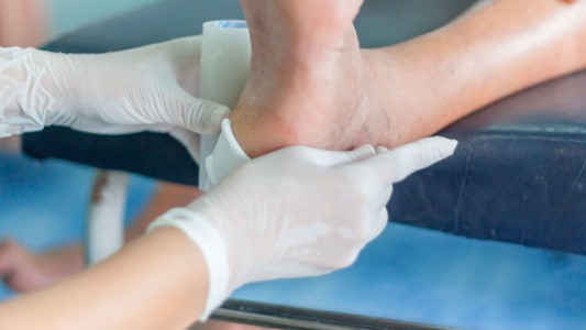 El 85% de las amputaciones a nivel mundial se deben al pie diabético